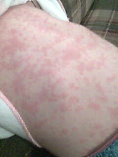 Emma's Hives on her belly