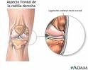 Lesiones meniscales