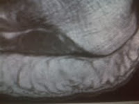 Foot Arch Pain
