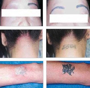 TATTOOS DESIGN: Laser tattoo removal cost
