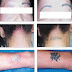 Laser tattoo removal cost