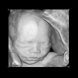 This a 3d ultrasound of a baby