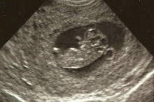 Ultrasound at 10 weeks