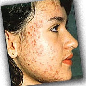 acne scabs