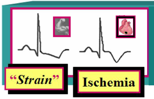 Ischemic Ekg