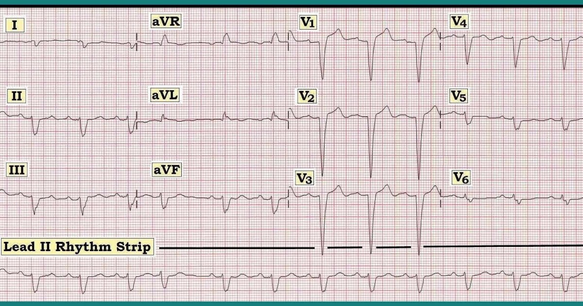 ECG Interpretation ECG Interpretation Review 13 (BBB, Wide QRS, Is