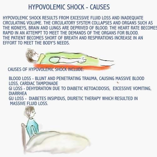 Dear Nurses HYPOVOLEMIC SHOCK