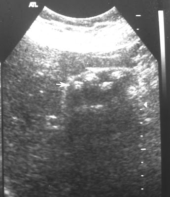 Cholesterol+gallstones+in+stool