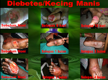 diebetes/kencing manis