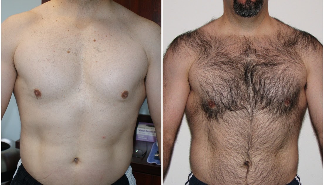 Laser Hair Removal Laser Hair Removal Los Angeles