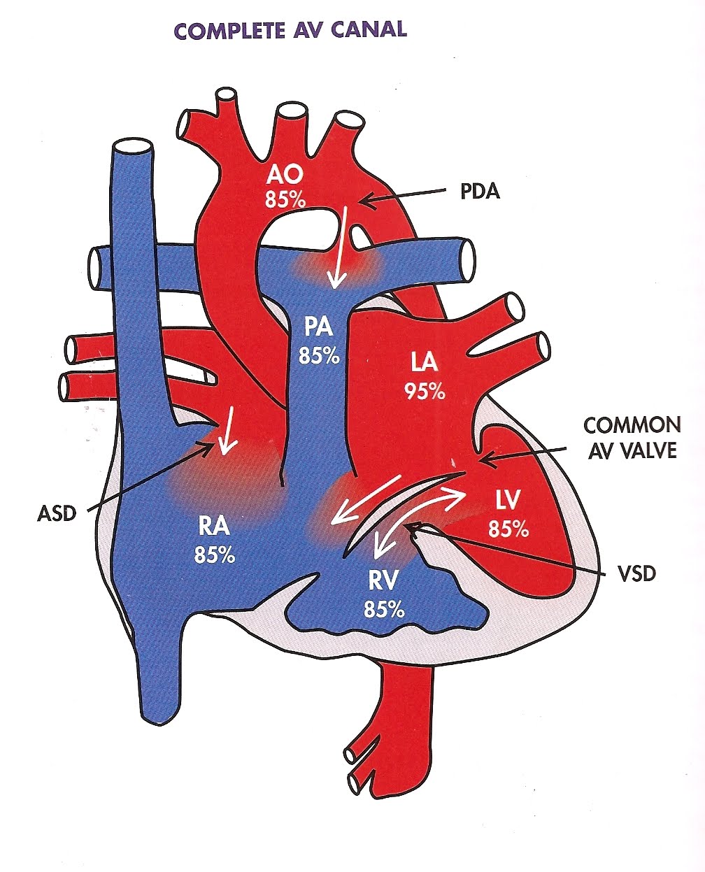 Endocardial Cushion Defects; Persistent Common Atrioventricular Canal