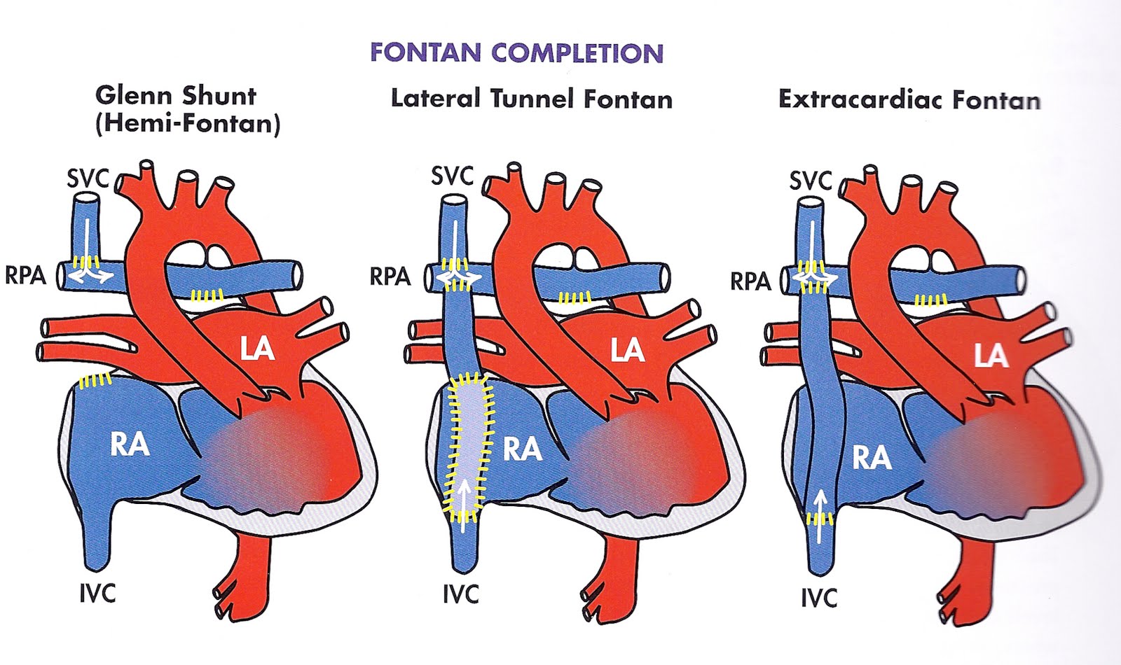 Hypoplasia of the Right Ventricle (Pulmonary Atresia with Intact
