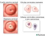 diferencia entre cuello uterino normal y con displasia cervical