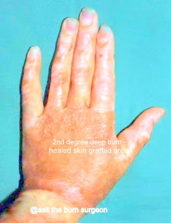 1st degree burn on hands