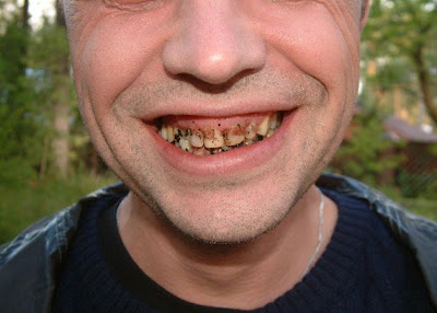 rotten-teeth-8.jpg