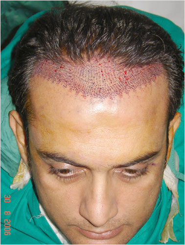 SHAHOOD ALVI (BEFORE SURGERY)