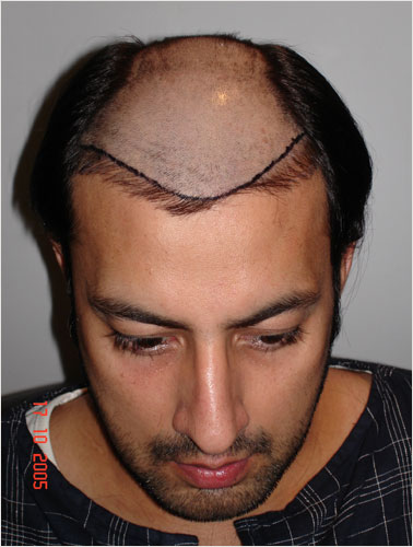 BABAR ALI (FILM & T.V ARTIST BEFORE SURGERY )
