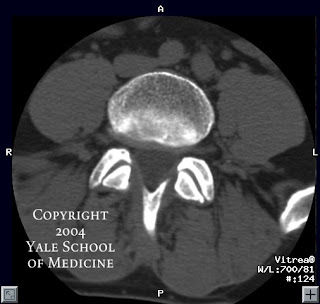 spine ct axial