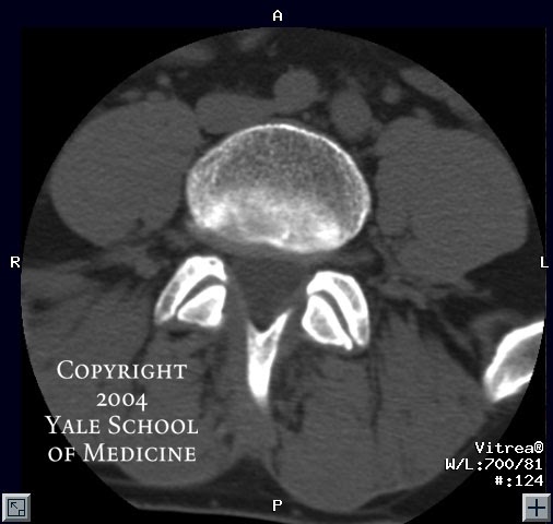 axial view ct spine