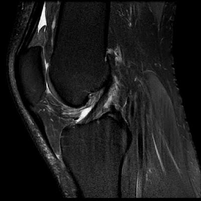 Radiology Cases: Quadriceps/Suprapatella Fat Pad impingement