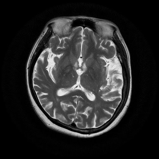 Radiology Cases Alzheimer Dementia