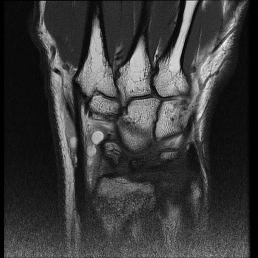 Radiology Cases Lipoma Aborescens Wrist 2nd extensor compartment