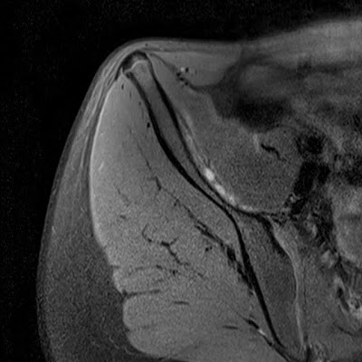 Radiology Cases: Iliacus Muscle Contusion with Submuscular Haemorrhage