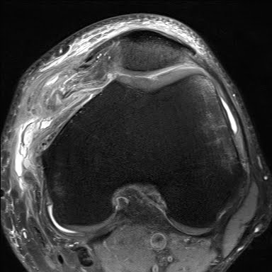 Radiology Cases: Transient Patella Disclocation