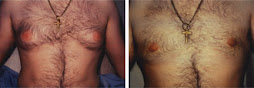 How To Cure Chest Fat For Men
