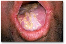 Oral Yeast Infection