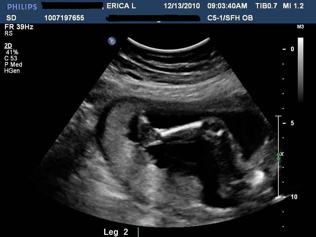 20 week sonogram 20 week sonogram