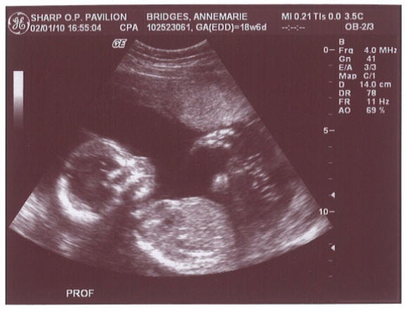 Live, Love, Laugh.: Fetal Anatomy Ultrasound Appointment