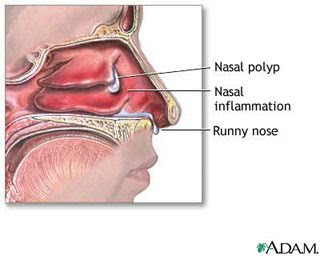 Nasal corticosteroid sprays india