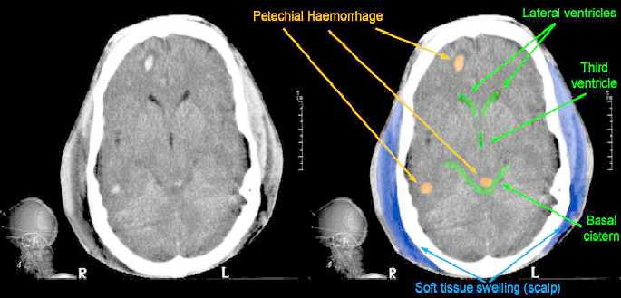 Normal+ct+scan+brain