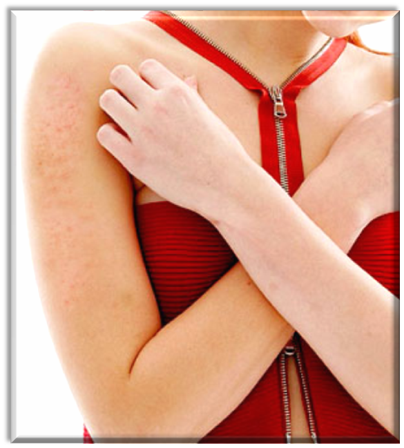 Las variedades de la psoriasis vulgar