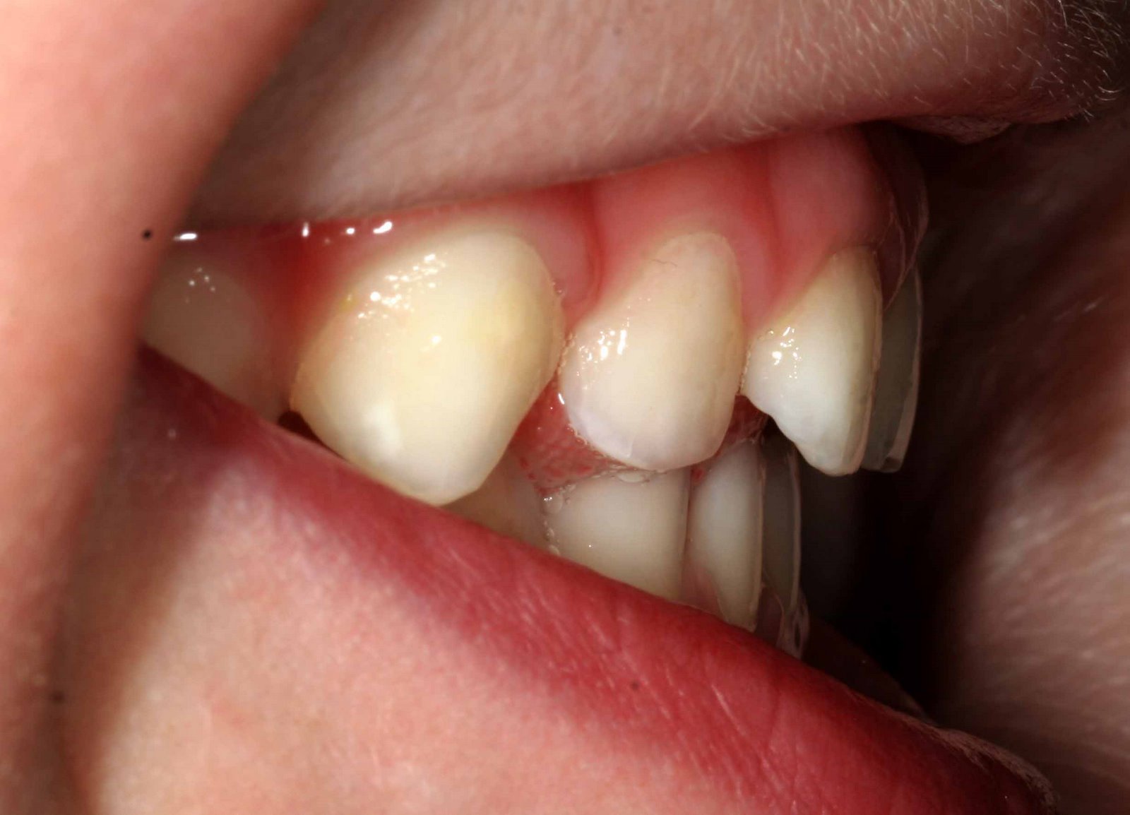 Overjet Overbite