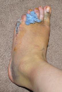 Hammertoe