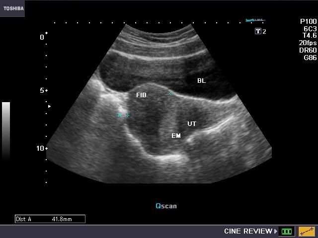 Uterine Ultrasound