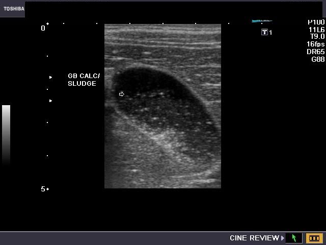 distended gallbladder