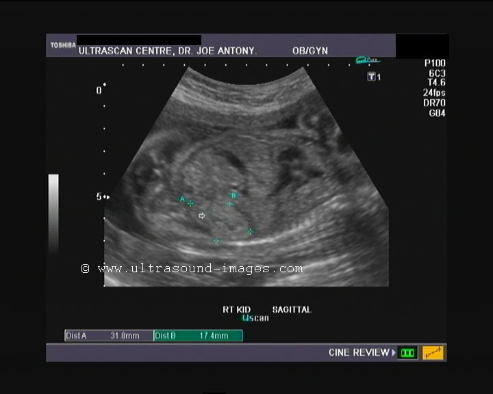 ultrasound of fetal kidneys