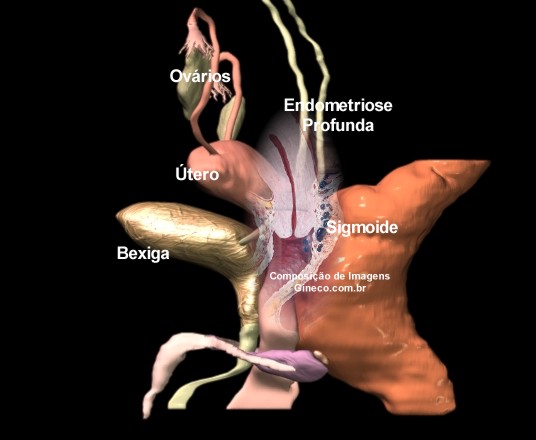 [endometriose_profunda.jpg]