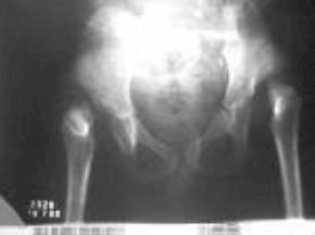 [artrogripose03.jpg]