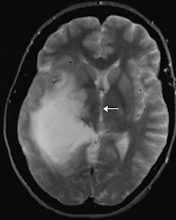 Contrast MRI of Temporal GBM