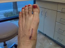 best shoes for saddle bone deformity