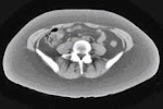 CT scan of high subcutaneous fat