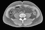 CT scan of high visceral fat