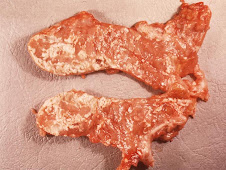 Necrosis grasa (peripancreática)