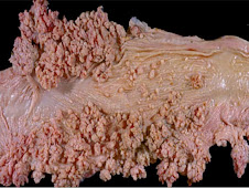 Papilomatosis en esófago (bovino)
