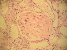 Amiloidosis renal (corteza)