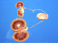 Atrofia renal e hipertrofia compensatoria